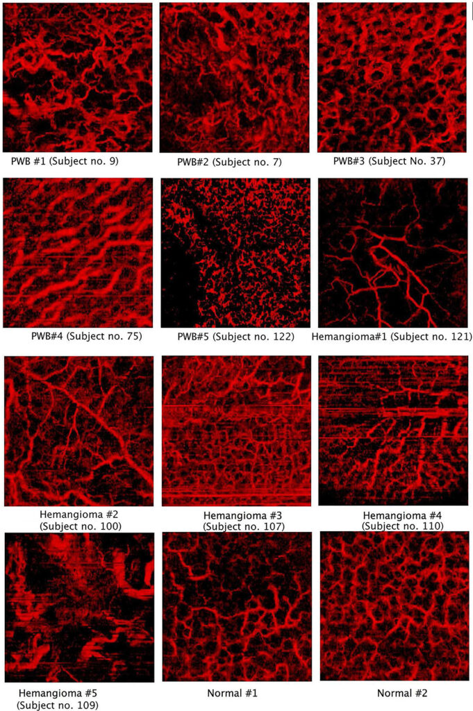 Proliferative Vascular Lesions VivoSight