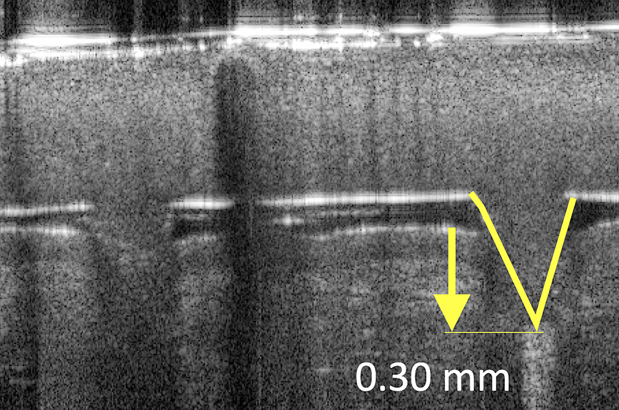Fig.2: MAP immediately after insertion into skin