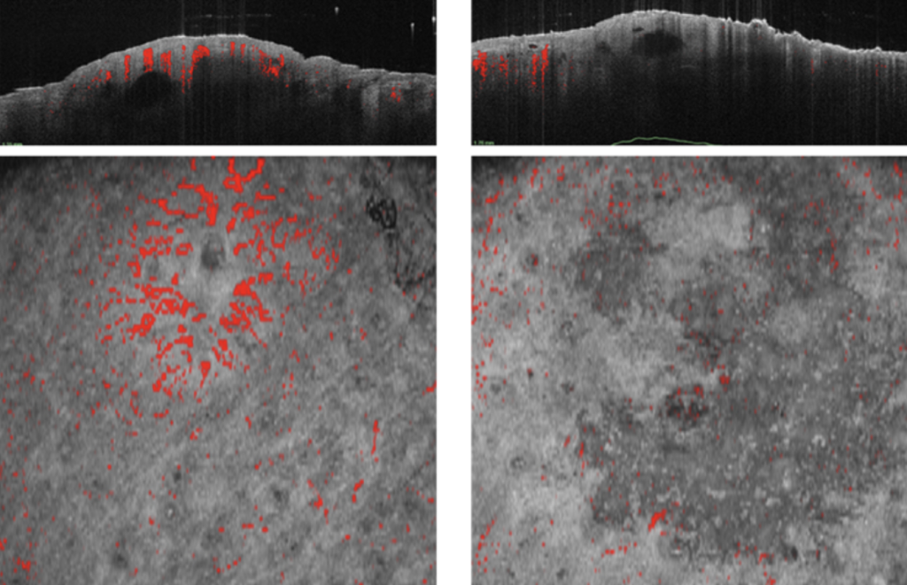 Laser Treatment of BCC