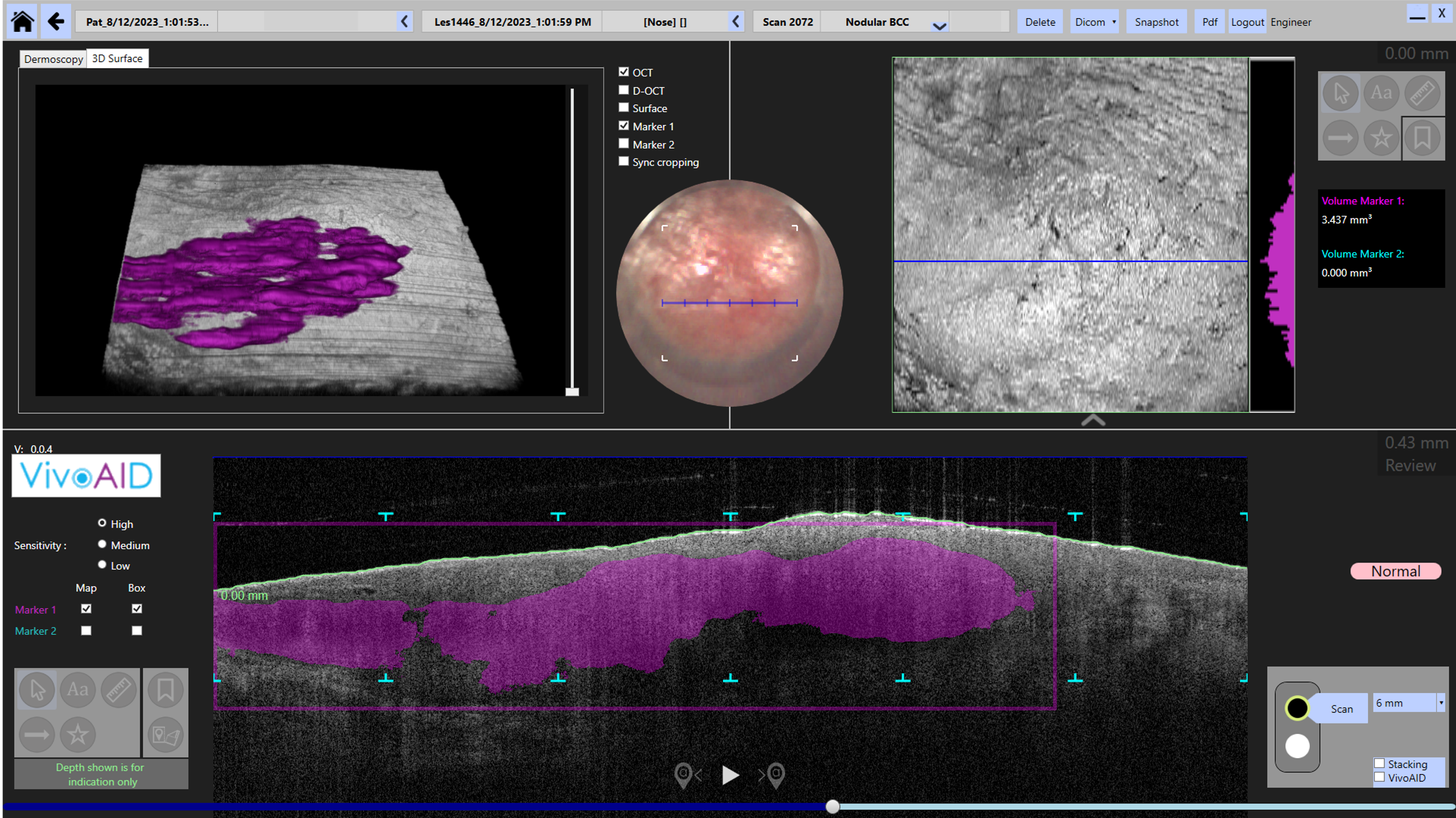 Nodular BCC with AI-placed image markers