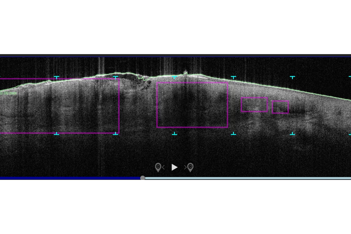 BCC image markers can be automatically placed on the OCT scan to assist and speed clinician' interpretation