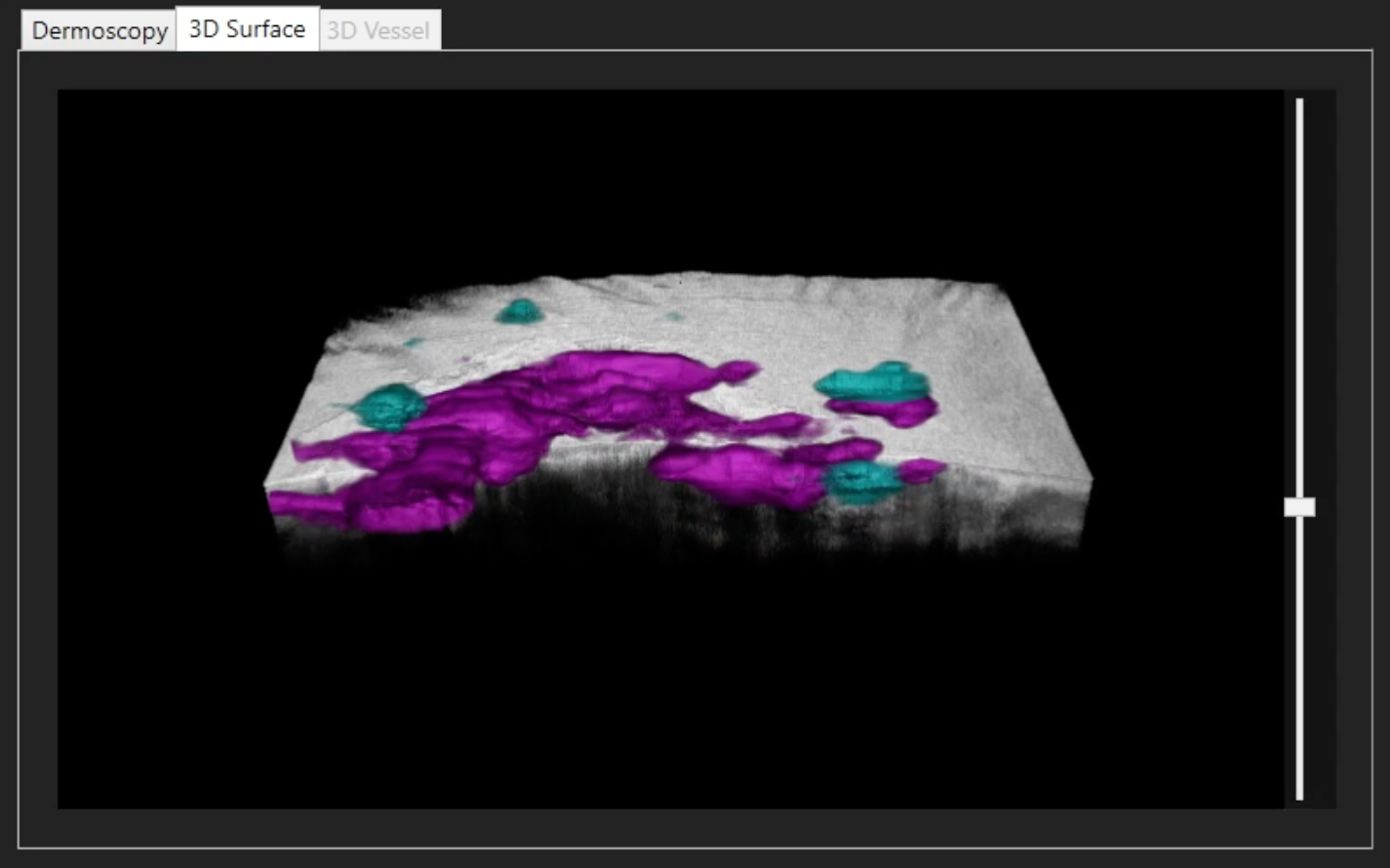 High resolution, 3D rendering of OCT image data, including skin surface and lesion image markers