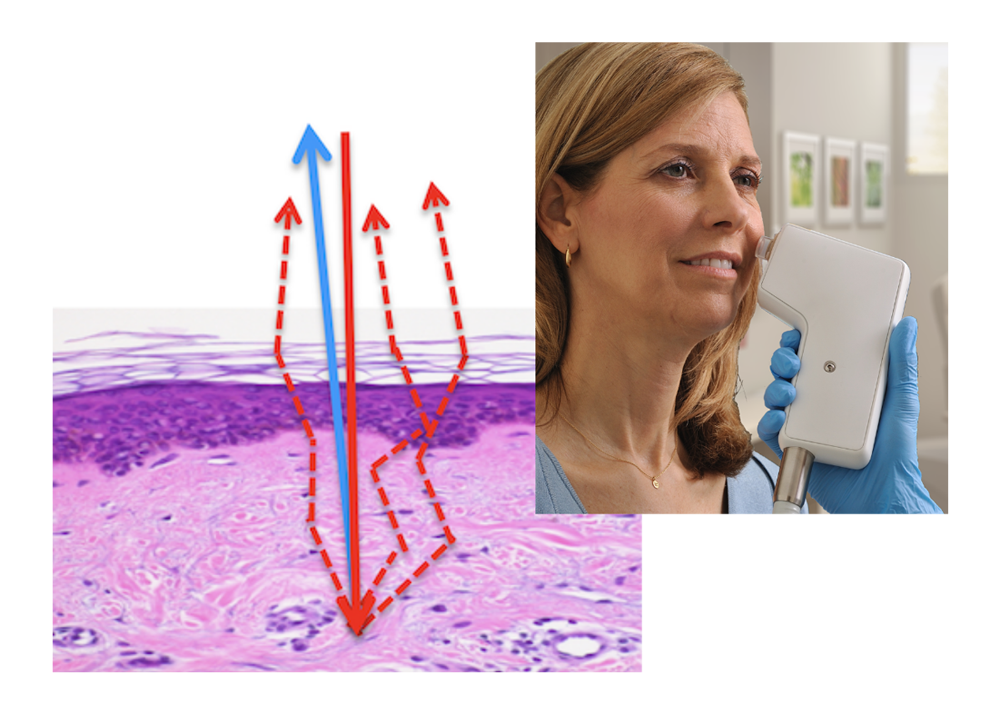 OCT skin imaging uses eye-safe laser to capture non-invasive, high res, images of skin structure and function beneath the surface