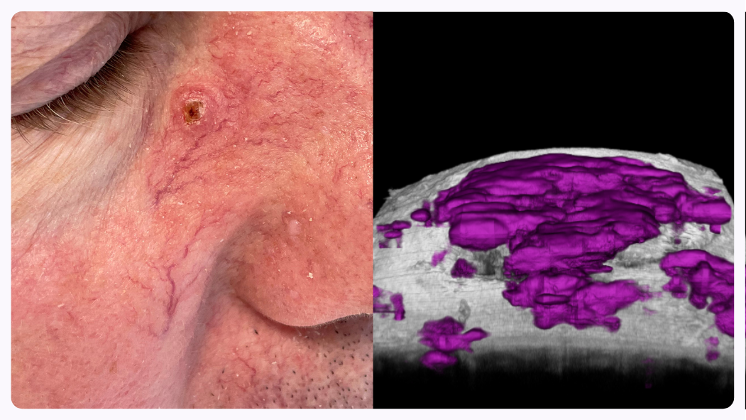 OCT BCC diagnosis with VivoSight Dx Pro